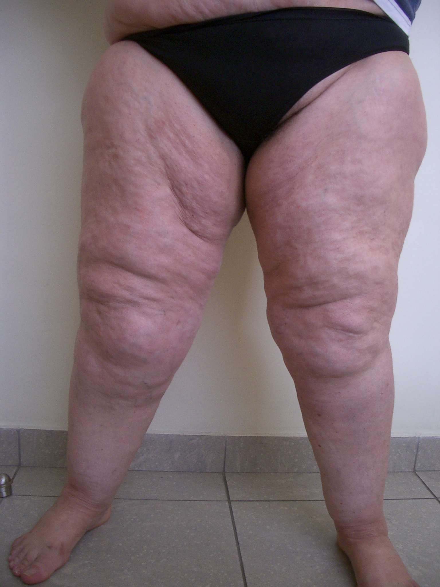 lipo