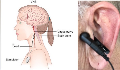 vagus nerve stimulator