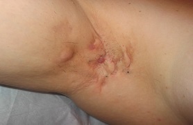 breast-cancer