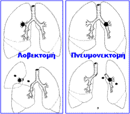 cancerlung1.jpg