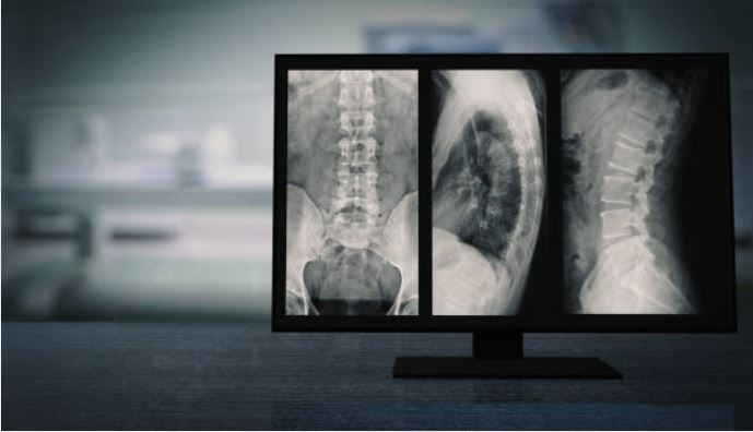 spinal injury