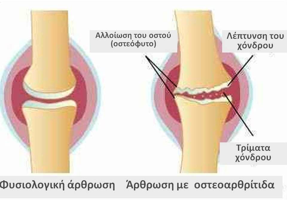 οστεοαρθρίτιδα