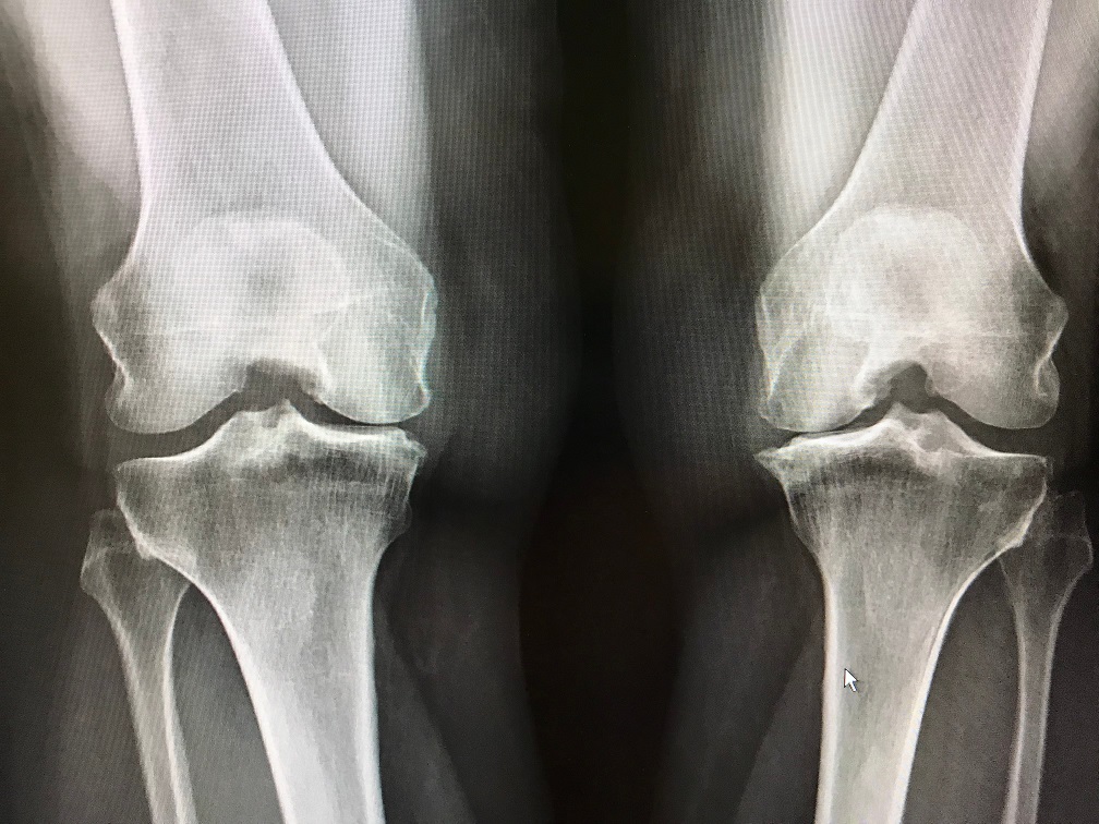 xray shows narrowing of bones at the knees cartil