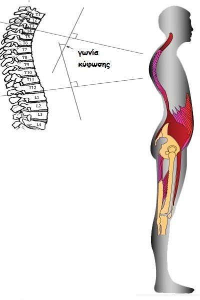 kyphosis