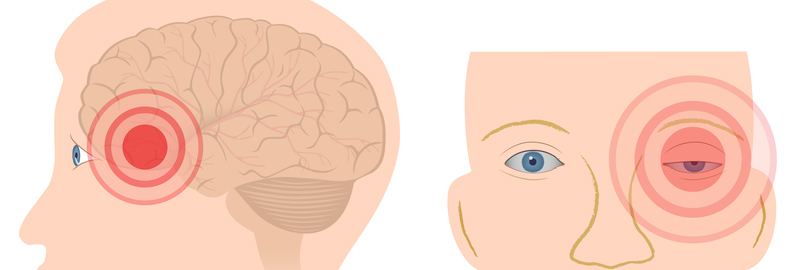 cluster-headache