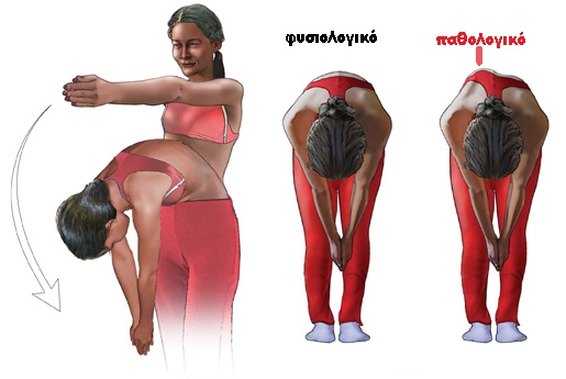 Scoliosis-2
