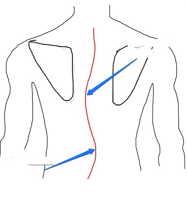 Scoliosis