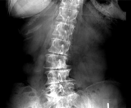scoliosis