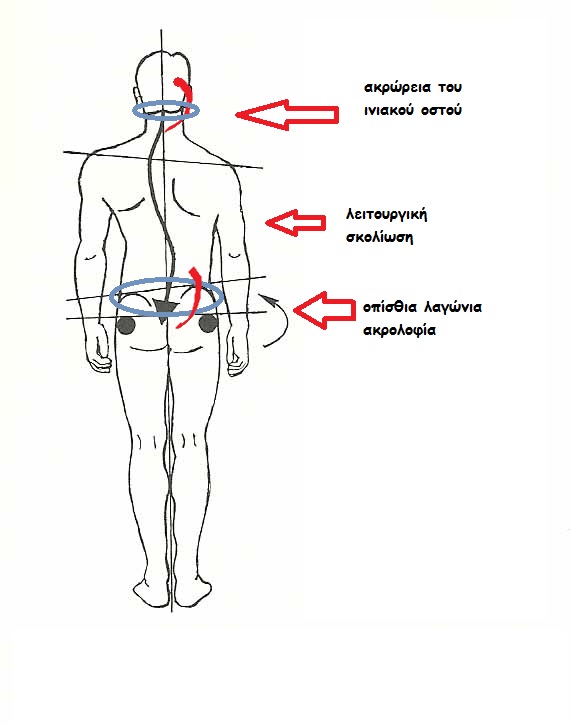 Scoliosis