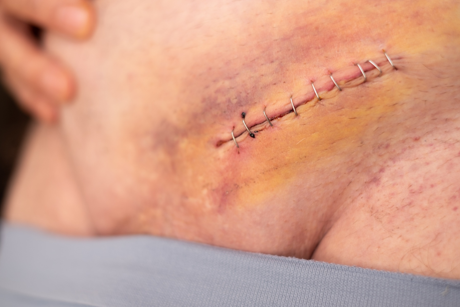 nine staples to the groin scar on the body of elde