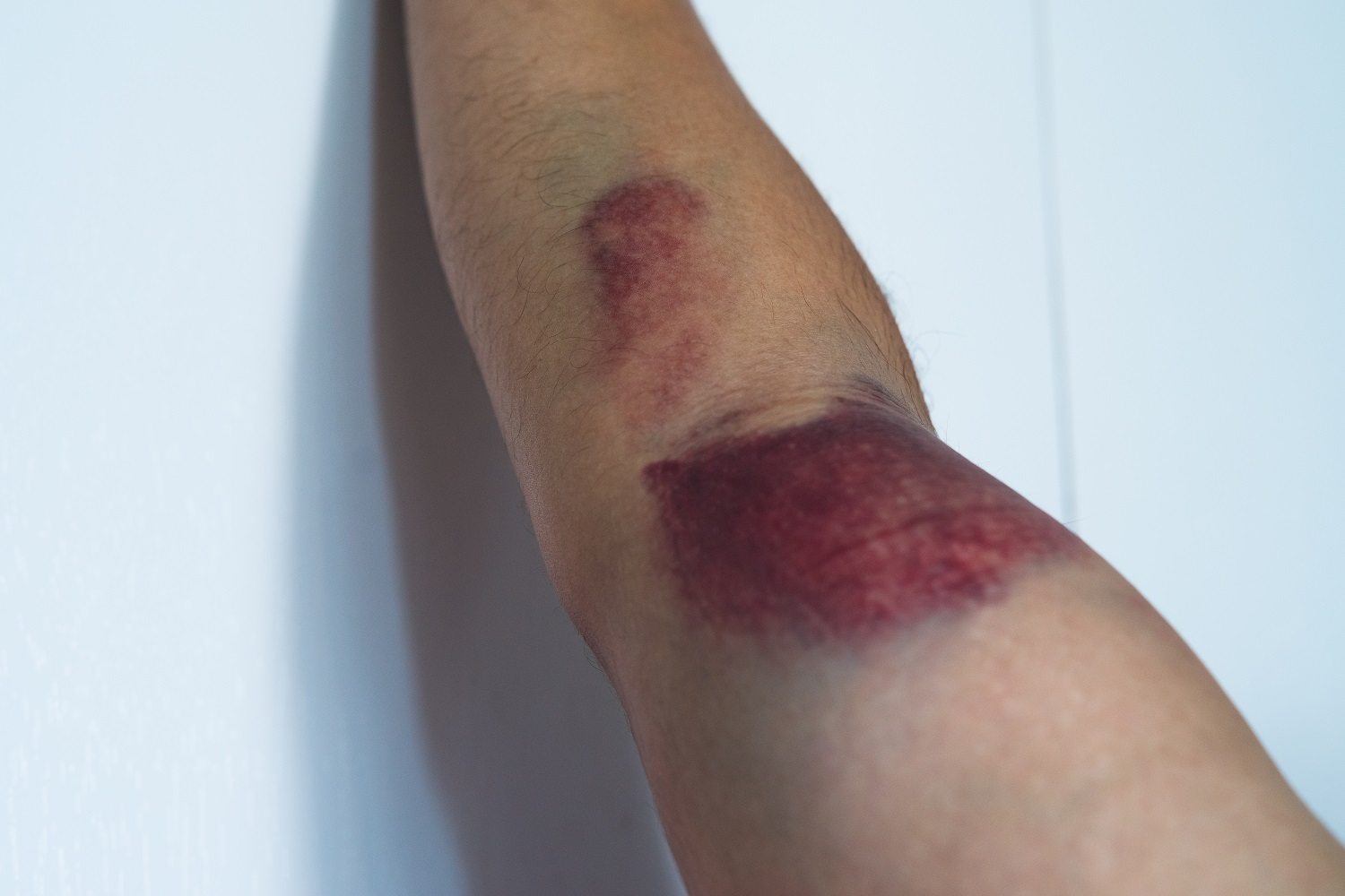 bicep tear or strain tendon injuries on a muscula