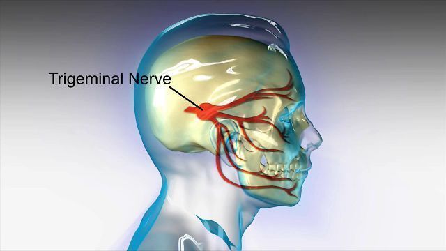 trigeminal-neuralgia