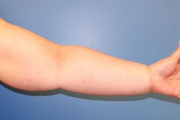 ΘΕΡΑΠΕΙΑ ΤΟΥ ΔΕΥΤΕΡΟΠΑΘΟΥΣ ΛΕΜΦΟΙΔΗΜΑΤΟΣ ΜΕΤΑ ΑΠΟ ΚΑΡΚΙΝΟ ΤΟΥ ΜΑΣΤΟΥ